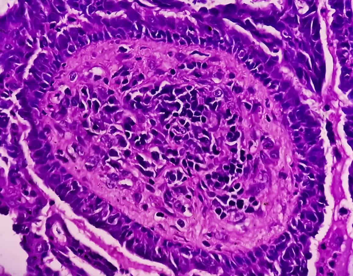Evaluated Impact of Triptorelin Peptide in Endometriosis and Cancer Studies